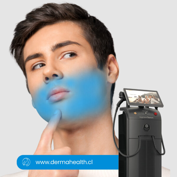 DEPILACIÓN LÁSER SOPRANO TITANIUM - Barba - 6 SESIONES