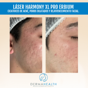 Láser Harmony XL PRO Erbium