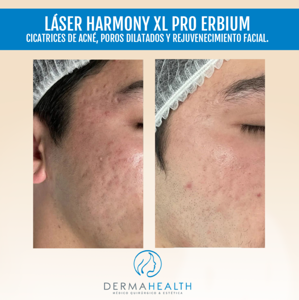 Láser Harmony XL PRO Erbium