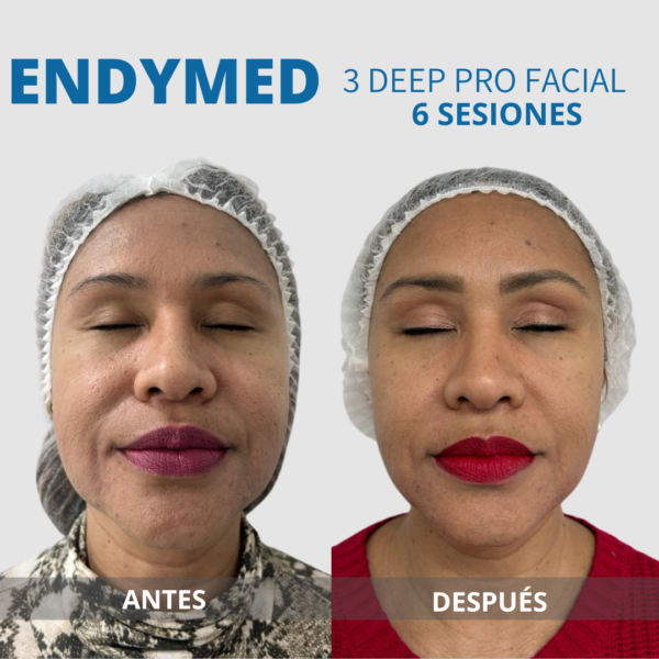 ENDYMED MINI SHAPER FACIAL