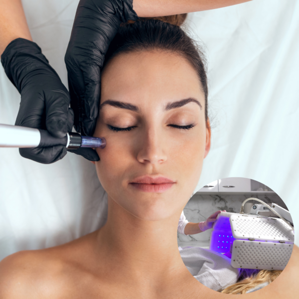 Plasma con Dermapen y vitaminas + máscara LED roja