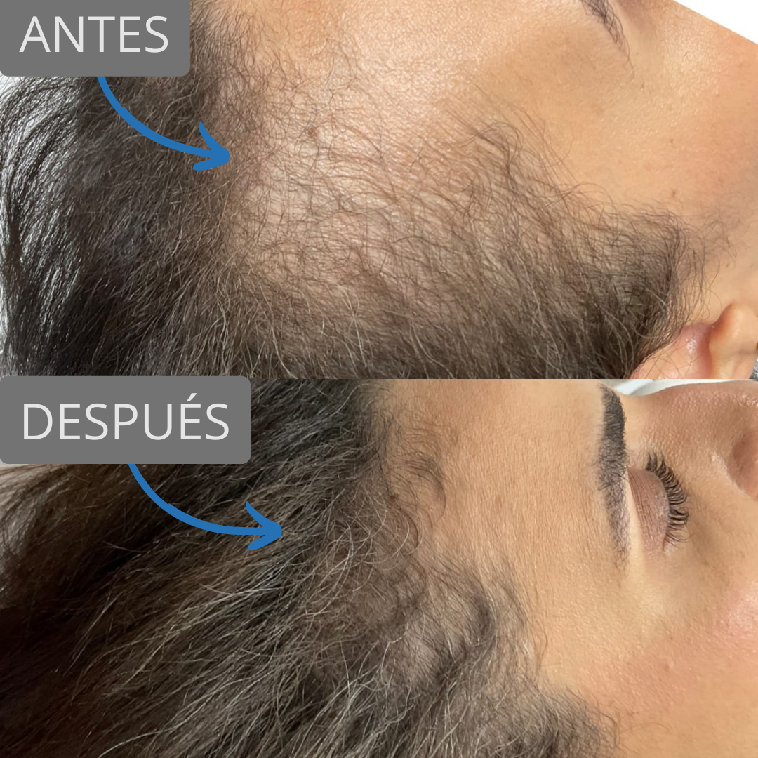 3 Sesiones de Plasma capilar rico en plaquetas más vitaminas y Láser de bioestimulación