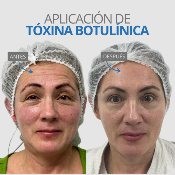 BOTOX