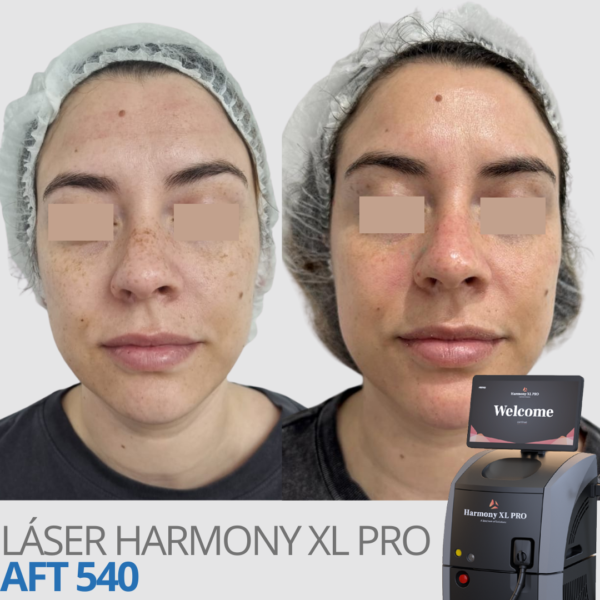 Láser Harmony XL Pro Alma láser - Luz  AFT