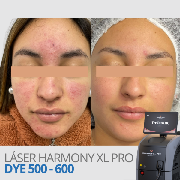 Láser Harmony XL Pro DYE 500 - 600