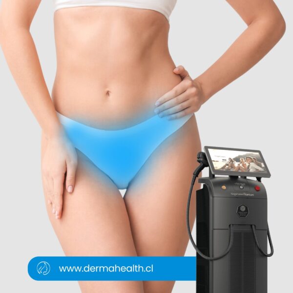 DEPILACIÓN LÁSER SOPRANO TITANIUM - Rebaje completo - 6 SESIONES