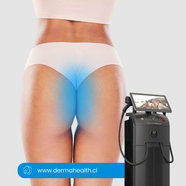 DEPILACIÓN LÁSER SOPRANO TITANIUM - Interglúteo - 6 SESIONES