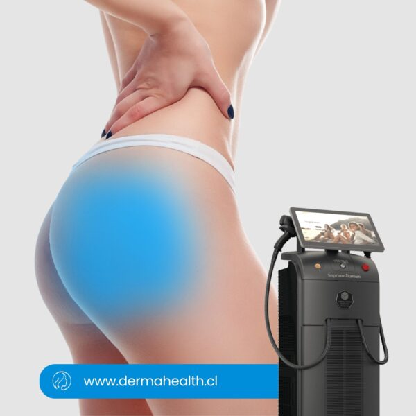 DEPILACIÓN LÁSER SOPRANO TITANIUM - Glúteos - 6 SESIONES
