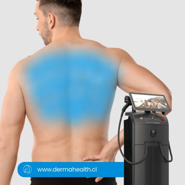 DEPILACIÓN LÁSER SOPRANO TITANIUM - Espalda hombre - 6 SESIONES