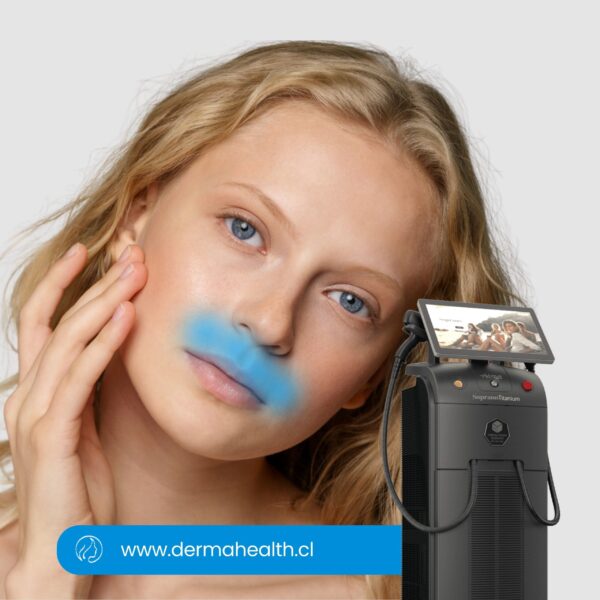 DEPILACIÓN LÁSER SOPRANO TITANIUM - Bozo (LABIO SUPERIOR Y MENTÓN) - 6 SESIONES