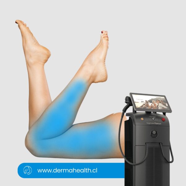 DEPILACIÓN LÁSER SOPRANO TITANIUM - Pierna completa - 6 SESIONES