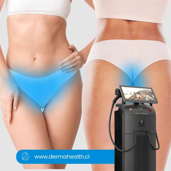 DEPILACIÓN LÁSER SOPRANO TITANIUM - Rebaje Full Brazilian - 6 SESIONES