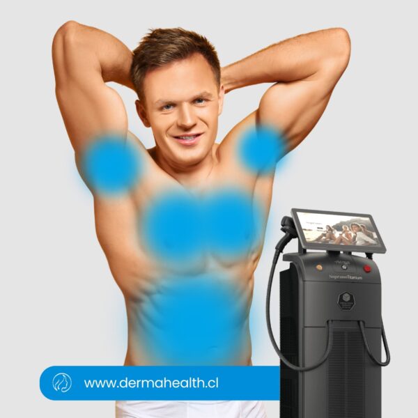 DEPILACIÓN LÁSER SOPRANO TITANIUM - Pack de axila, pecho, abdomen y espalda completa - Hombre  - 6 SESIONES