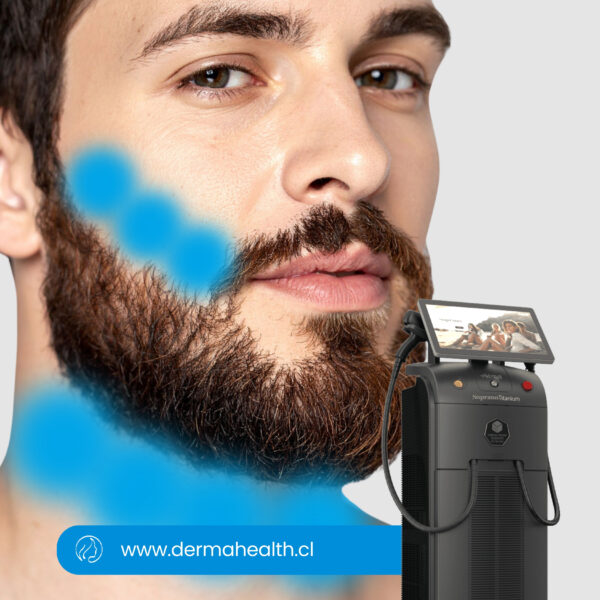 DEPILACIÓN LÁSER SOPRANO TITANIUM - Pack de marcación de barba - Hombre  - 6 SESIONES