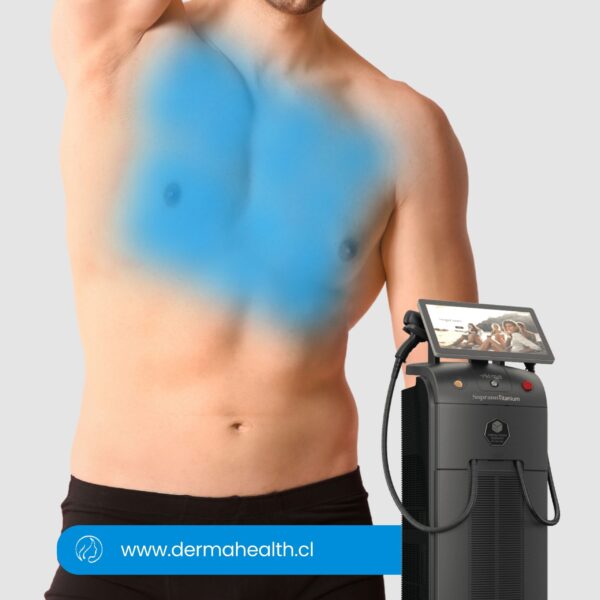 DEPILACIÓN LÁSER SOPRANO TITANIUM - Pecho hombre  - 6 SESIONES