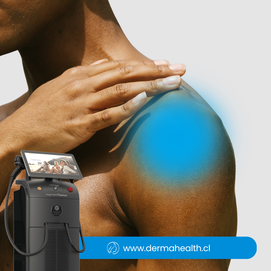 DEPILACIÓN LÁSER SOPRANO TITANIUM – Hombro- Hombre – 6 SESIONES